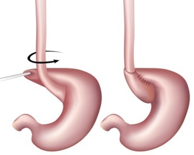 fundoplication