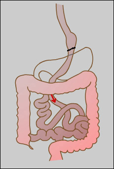 Laparoscopic Gastric Bypass