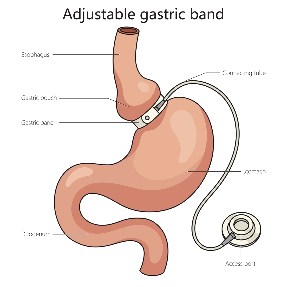 gastric band