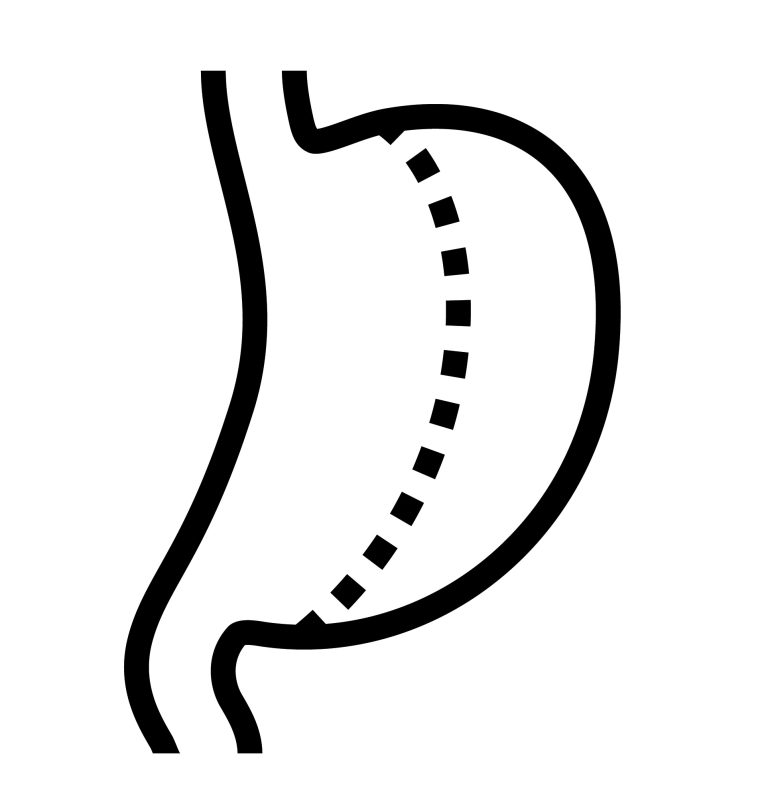 gastric sleeve